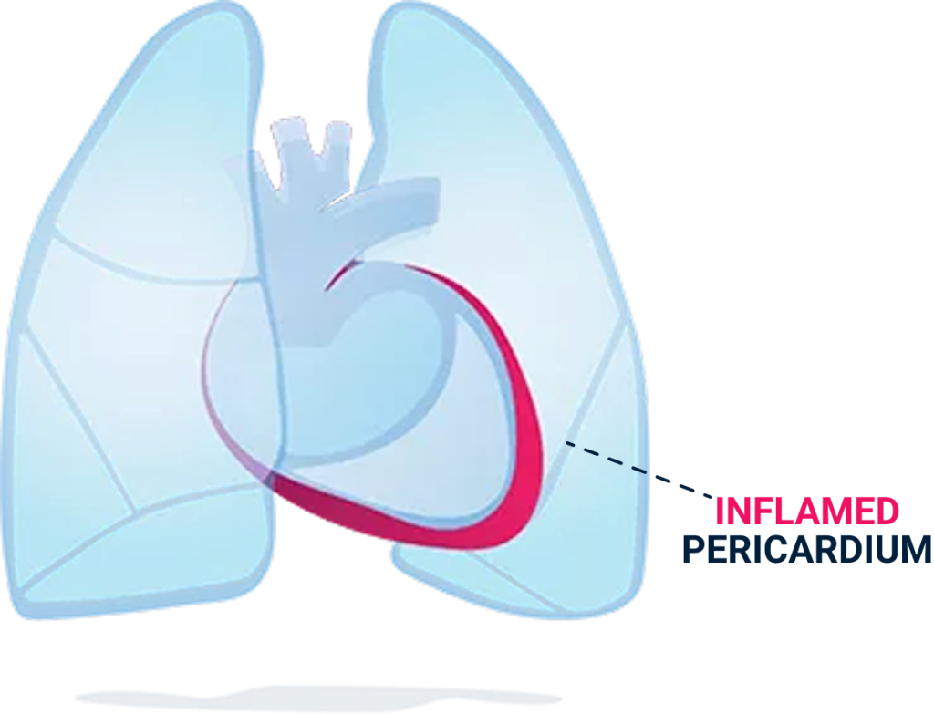 Inflamed pericardium.