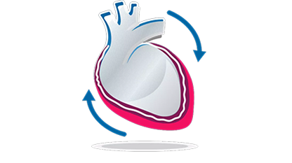 Recurrent Pericarditis Heart.